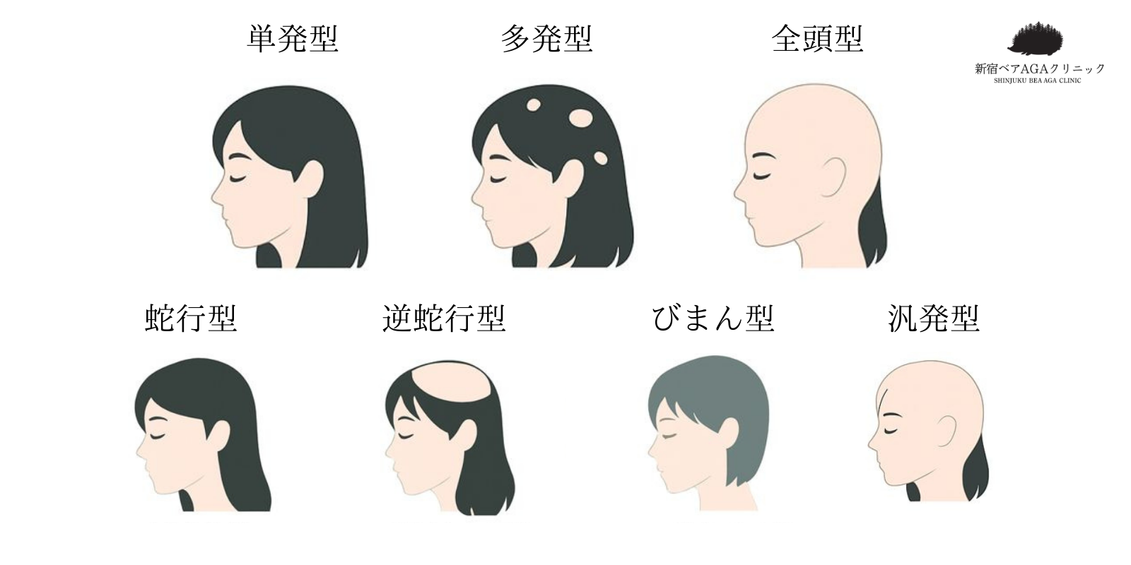 円形脱毛症の代表的なパターン図（単発型・多発型・全頭型・汎発型・蛇行型・逆蛇行型・びまん型など）