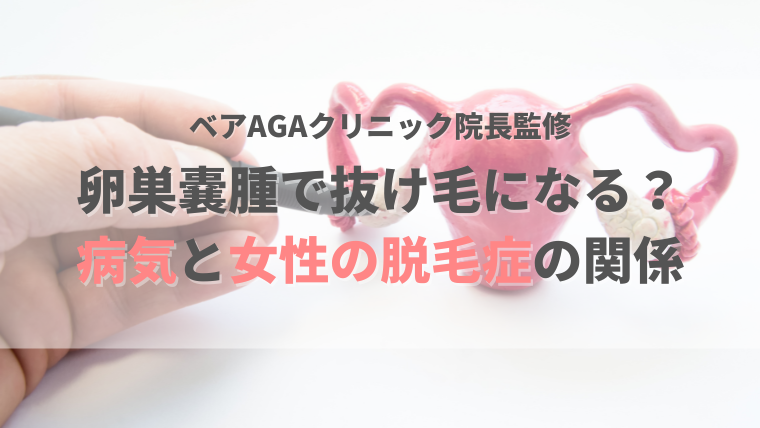 卵巣嚢腫が原因で抜け毛になる？女性ホルモンの乱れや生理不順が起きやすい病気と女性の脱毛症の関係を解説