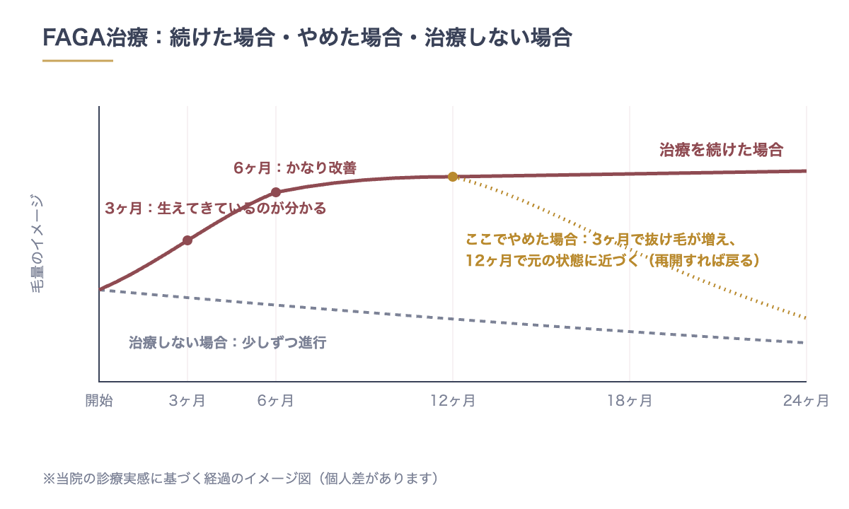 FAGA治療の経過：続けた場合は3ヶ月で生えてきているのが分かり6ヶ月でかなり改善。途中でやめた場合は3ヶ月で抜け毛が増え12ヶ月で元に近づく。治療しない場合は少しずつ進行